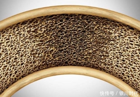 骨質(zhì)疏松“偏愛(ài)”6類人,需特別關(guān)注骨骼健康,看看你是否在其中
