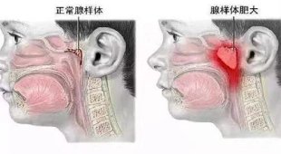 腺样体肥大怎么办？中医调治有妙招！|耳鼻喉医话 | 五指毛桃