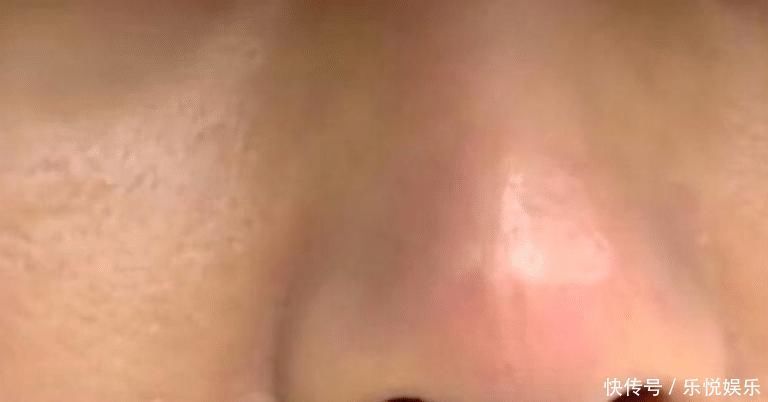 想要鼻子更秀气一点,术后竟然像“果冻”,女子吓得不敢出门