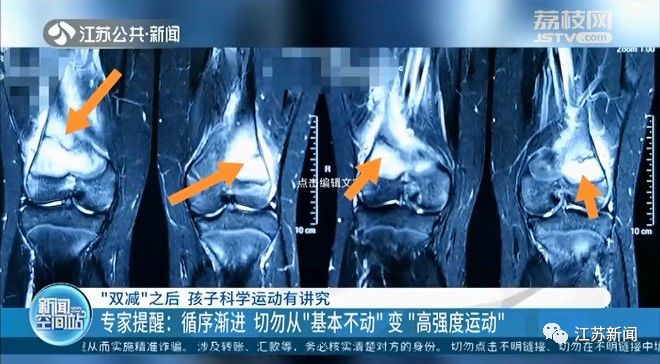 检查|14岁男生喊腿疼，进医院检查才发现……近一个月已接诊十多例！