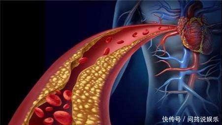 软化血管|''软化血管''骗了囯人30年,什么木耳、洋葱,都是胡扯