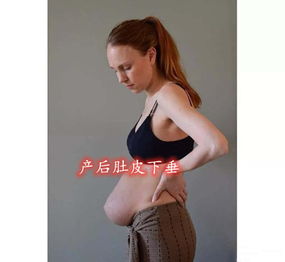 腹白线|丹麦妈妈怀上三胞胎,产后肚皮却“收不回去”,看完照片感同身受