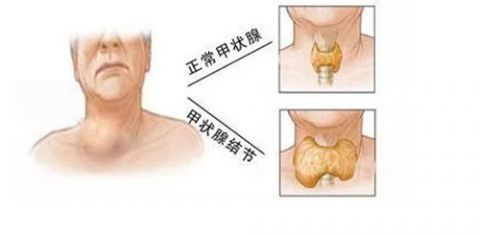 增生|结节、息肉、囊肿、增生...哪个才是癌症的先兆