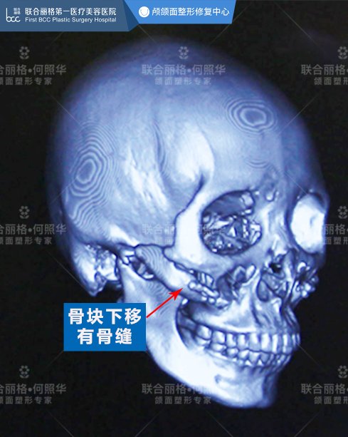 牵拉力|颧骨内推后,面部皮肤一定会下垂吗？看完秒懂