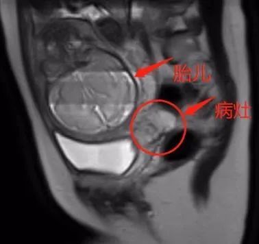 妈妈|怀孕25周查出宫颈癌,年轻妈妈做出这样一个决定