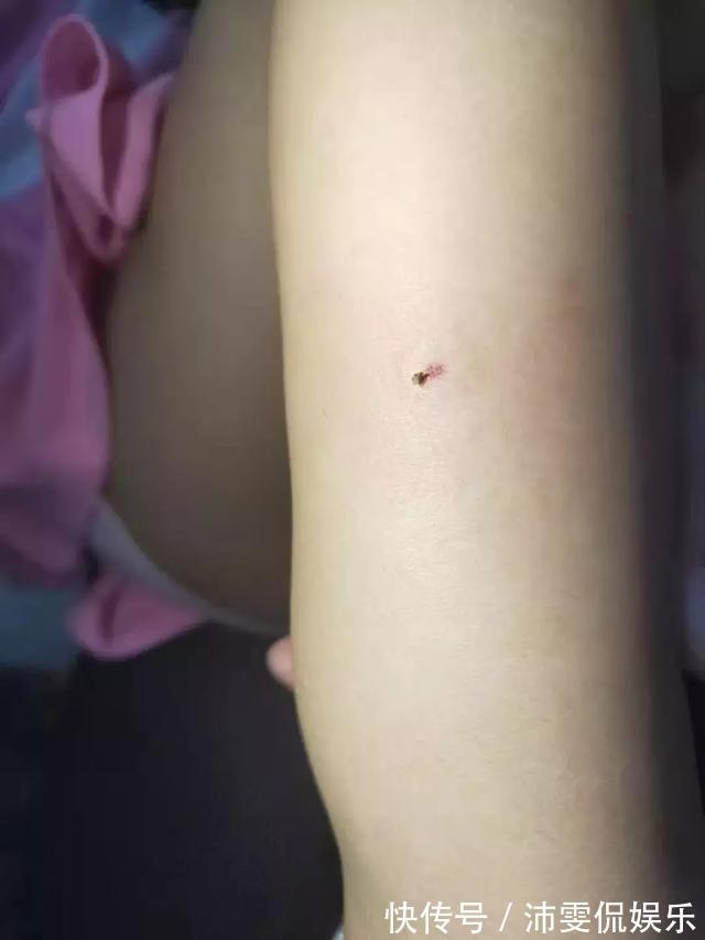 妈妈|3岁女孩因为一根刺险丧命!妈妈的这个做法救了孩子!