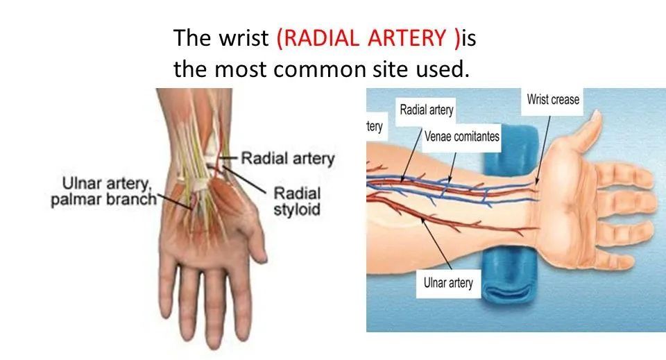 套管|聚焦临床丨盲法桡动脉穿刺，深度解析！