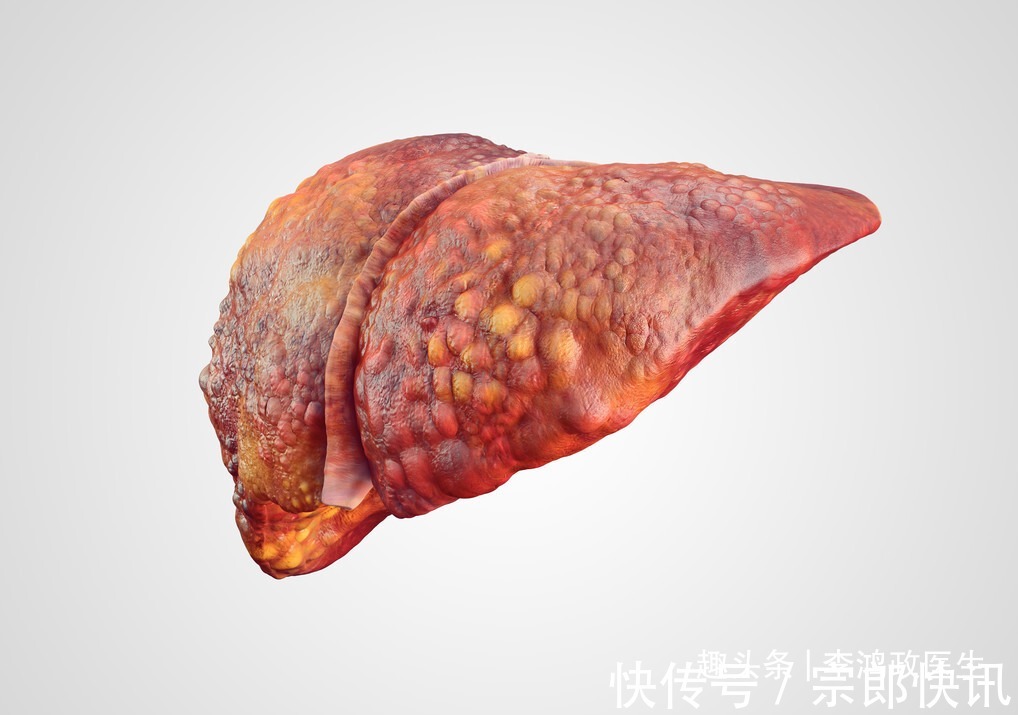 肝硬化|年轻女子月经紊乱,以为普通妇科疾病,患者似笑非笑脸惊醒医生