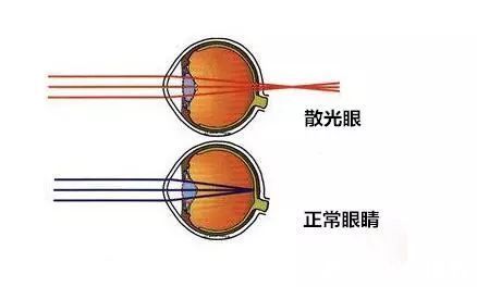 散光|【科普】---散光的危害!