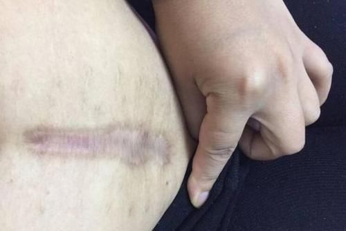 剖腹产|顺产比剖腹产强100倍?剖腹产这3大优点,顺产根本没法比