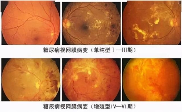 青光眼|世界残疾人日：超过60%的致盲病因来源于这5种眼病