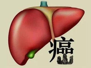 肝癌最喜欢找这3种人，做好5件事，能逃过一劫！