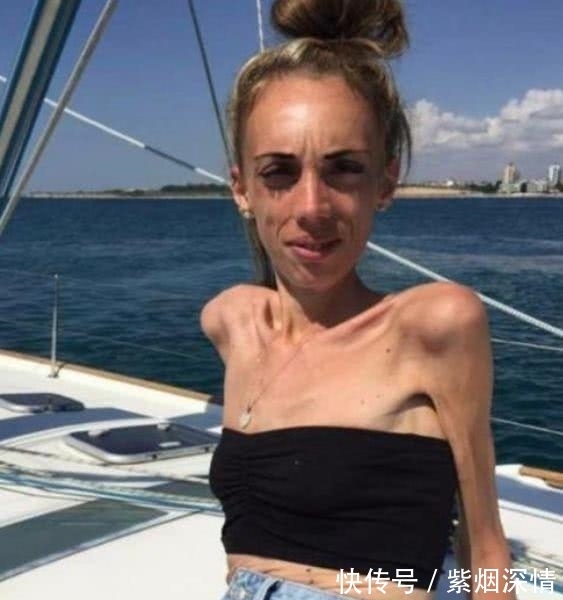 身材|国外女子瘦到27公斤,走在街上人人都躲着她,增肥后却惊艳众人!