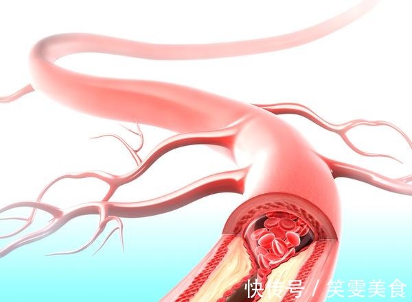 糖尿病|想要降脂并不难,少吃1类食物,血脂会悄悄恢复正常