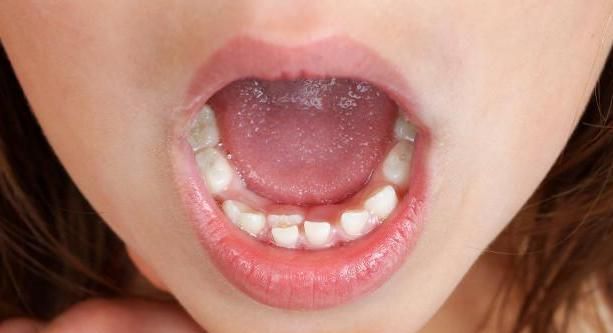 糖果|越来越多孩子长“双排牙”，与糖果无关，是父母喂养有误区