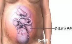 宫颈|分娩时，出现以下8种情况的产妇务必选择剖腹产，千万别犹豫误事