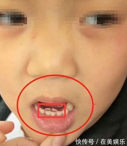 牙齿|8岁男童长出“双排牙”,被拔掉时疼哭了,得知原因后奶奶崩溃
