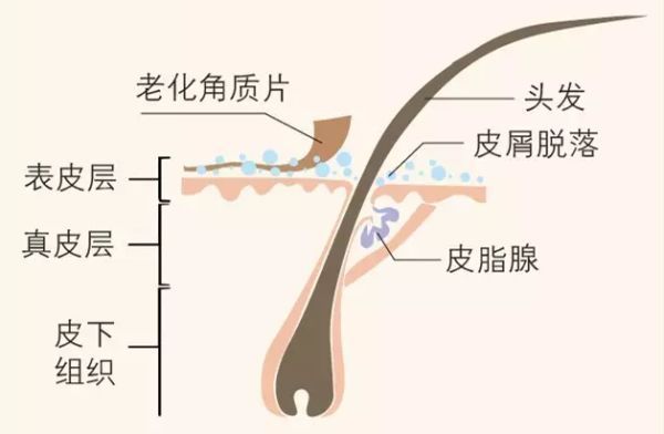 酮康唑|来自皮肤科医生的警告：头屑多，可能是脱发前兆