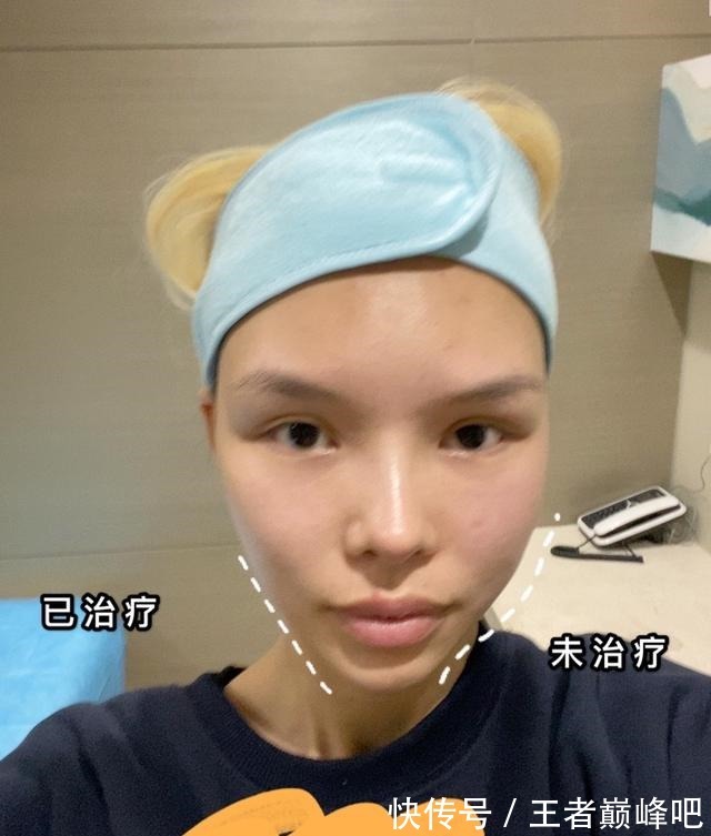 紧致 面部抗衰老,选热玛吉还是线雕提升!