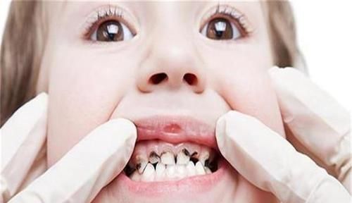 健康|孩子长了一口“鲨鱼牙”,妈妈着急送医,医生:无知害了孩子