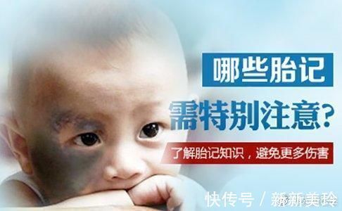 胎记|胎记需要治疗吗?医生告诉你,这些胎记不治疗真的不行!