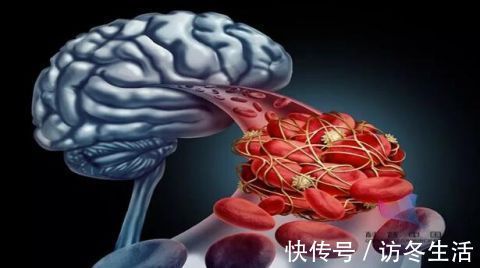 脑出血|这种菜吃多了会导致脑中风出现这些症状要小心