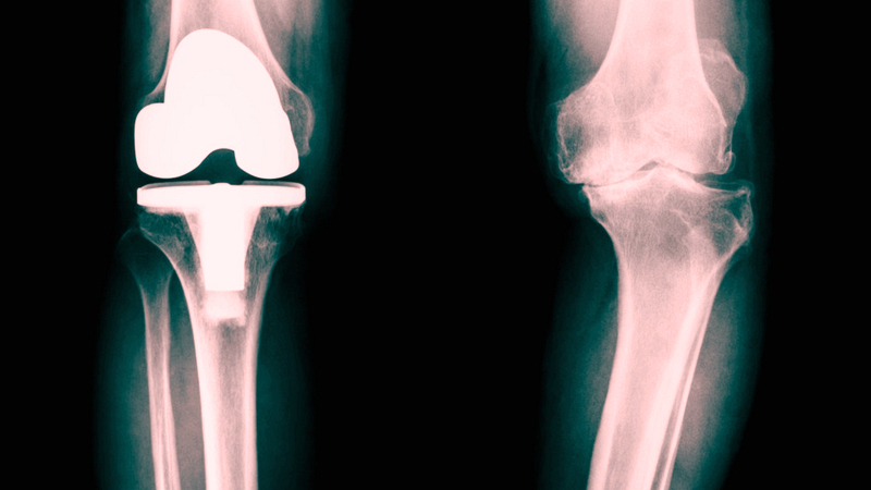 退化性关节炎|人为什么会得关节炎医生关节炎可不是“一个”病