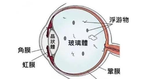  视网膜脱落的3个前兆！别拖延，及时发现及时治疗