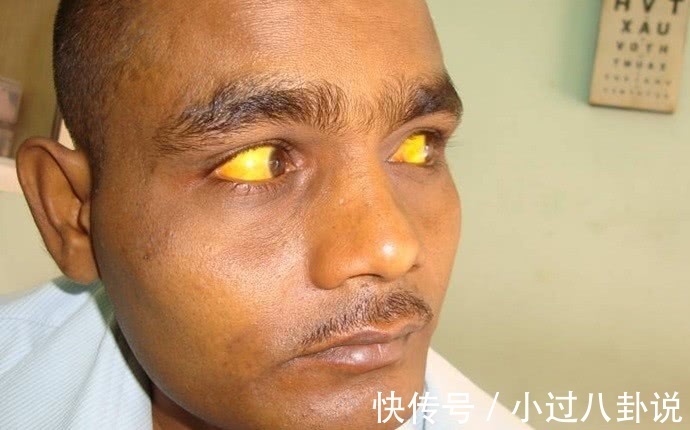 消化道出血|脸上出现这3种破绽，是肝不好？3个异常，或是肝脏病变