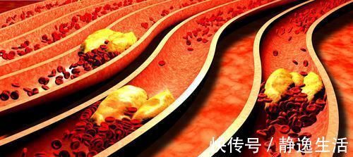 胆固醇|伤血管的“家常菜”已公布,提醒:血脂高的人,早点拉入黑名单