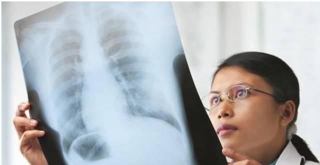 醫生說,發現肺結節基本沒啥大事,但出現這5個癥狀要及時防治!