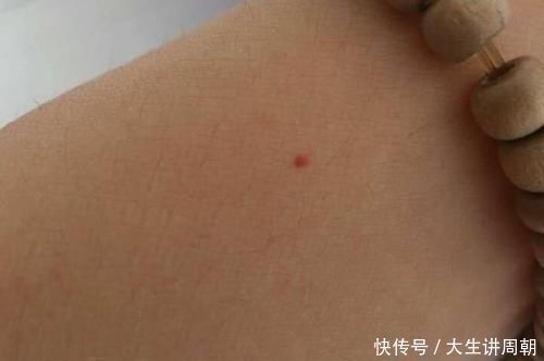 蜘蛛痣|身上突然长出这种小红痣,别大意,可能是某些疾病的预警信号