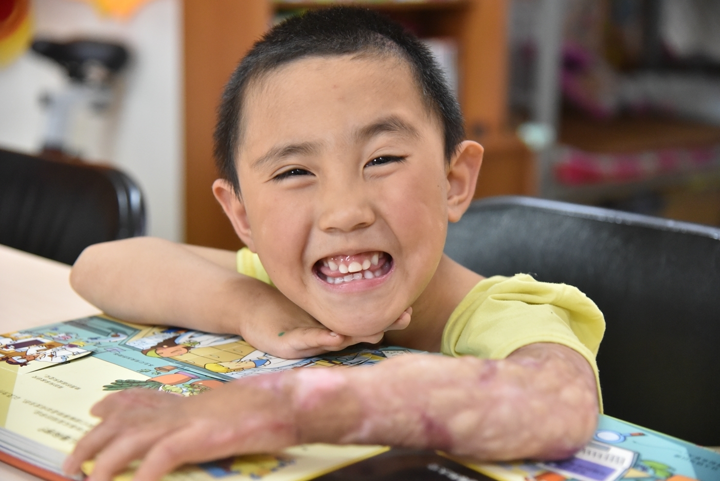 孙女|偏方害死人!孙女被烫伤后,奶奶用鸡蛋液敷上,医生直言无知