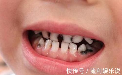 医生|宝宝去幼儿园被说“口臭”,医生从嘴里取出这个,很多孩子都有