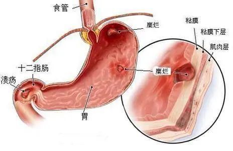  靠近|80后夫妻查出胃癌，当心两种饮食习惯让胃癌悄悄靠近！