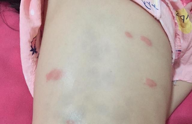 孩子随时随地都在挠痒痒?大多都是螨虫在作怪,家长要警惕