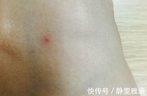 健康|为啥到了年纪后，身上会长出小红痣？为了健康，务必了解！