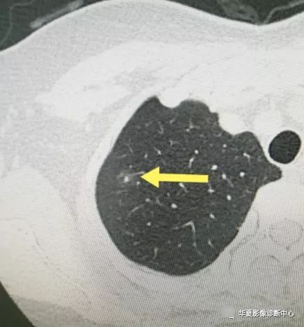 患者|从肺结节到肺癌，10个月影像记录，提醒我们正确对待肺结节处理