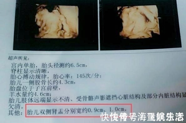 尿液|胎儿双肾盂分离,孕妇很高兴,“这下儿女双全了”,医生苦笑摇头