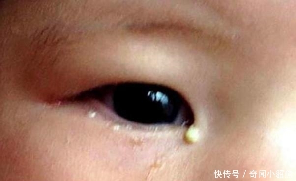 母亲|半岁女孩发烧, 医生将针扎入眼角, 眼角流出液体, 母亲无法淡定