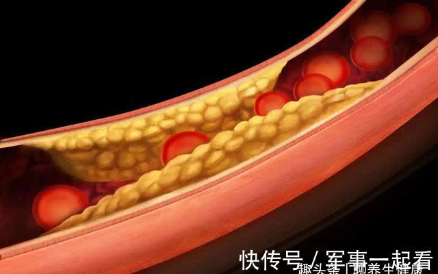 血管堵塞|血脂偏高的人,头部或有4个表现,若想调节血脂,给你2个小建议