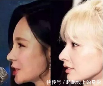 风险 鼻炎能做隆鼻手术吗隆鼻之后会有哪些术后风险!