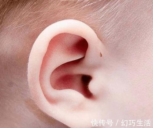 宝妈|为啥有些新生儿耳朵有小孔?医生一般不会主动讲,家长心里要有数