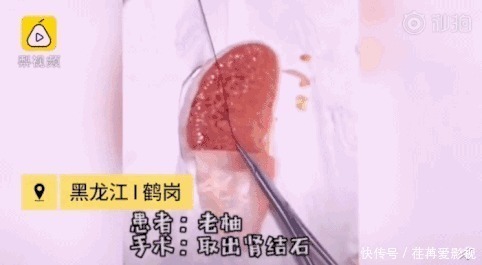 王醫生|32歲醫生竟給水果做手術？一夜吸粉12萬！網友：“我的膝蓋跪爛了”