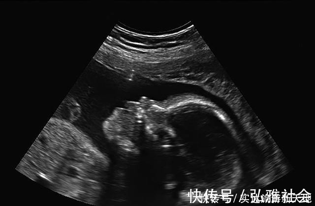 测量|孕期B超单直接反应胎儿状况,这5处孕妈要学会看懂,医生不会详说