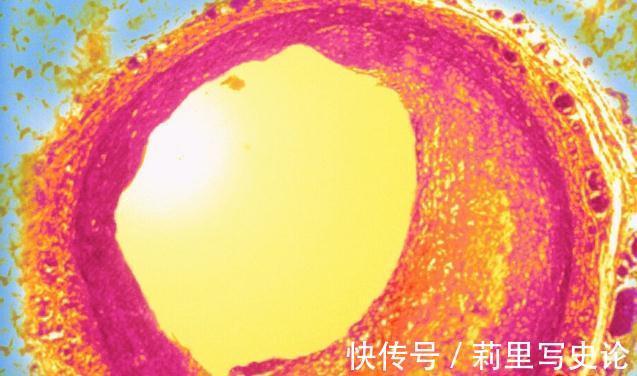 疫苗|“血脂疫苗”正式启用了,每年只需注射两次,什么人都可以打?