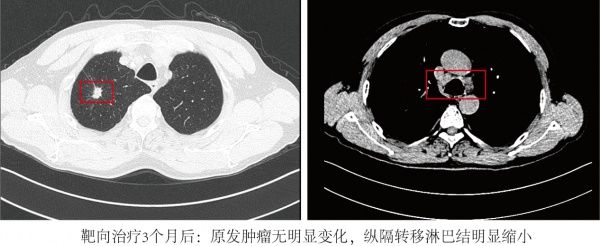 达芬奇|靶向治疗“降期”后重获手术机会，肺癌晚期男子术后3个月再渡江