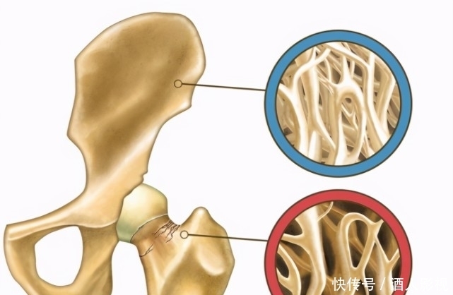 營養物質|骨質疏松的“加速器”公布,比煙酒更傷骨,醫生提醒:勸你管住嘴