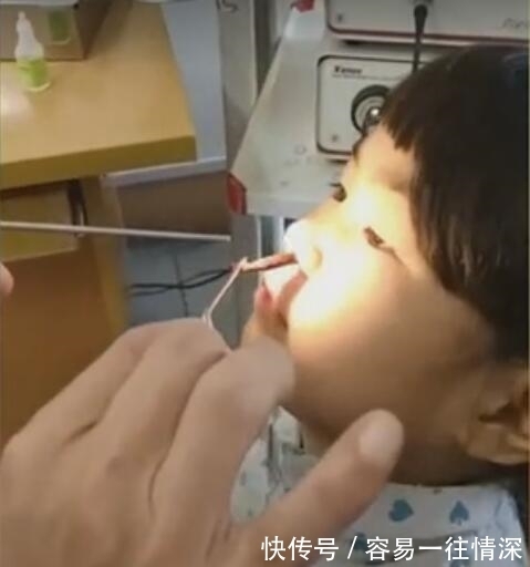 活虫子|奇闻：医生从小女孩鼻子里取出一条活虫子，女孩看见后一脸淡定