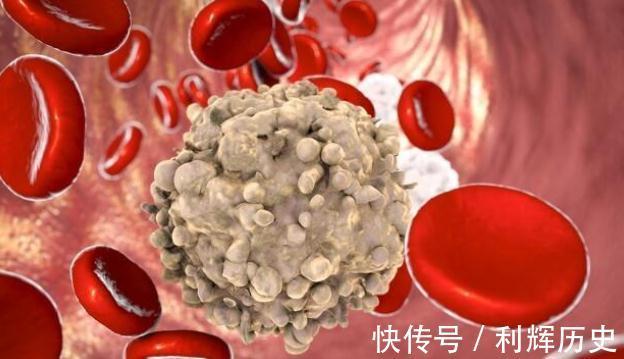 疼痛|注意,癌症早期有这些症状,早发现、早诊断、早治疗,提高治愈率